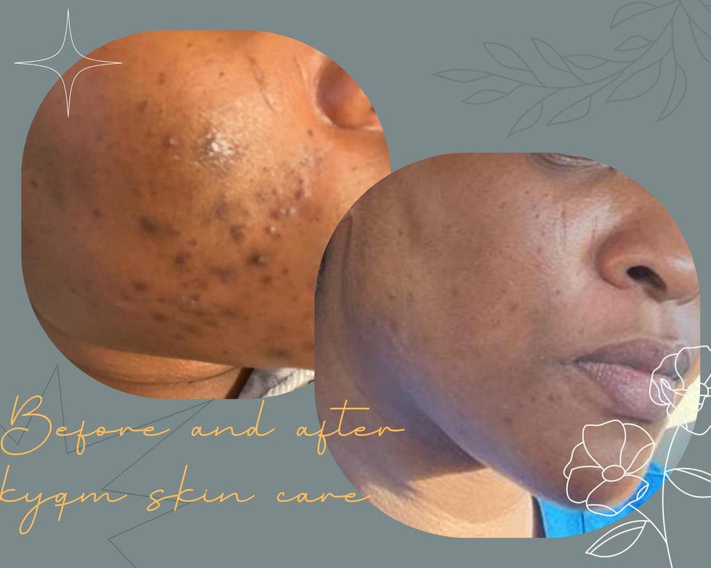 acne-removal-turmeric-face-soap